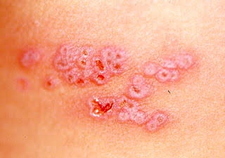 【ウイルス感染症】水ぼうそう（水痘）について知っていること　※帯状疱疹も可