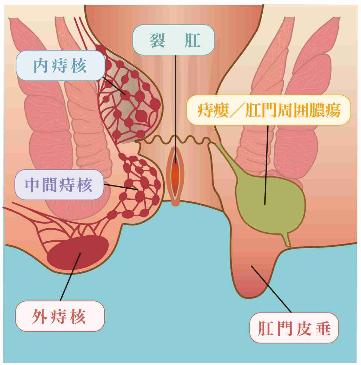 痔に悩む人