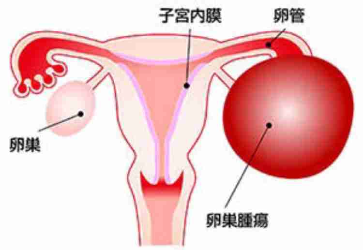 卵巣嚢腫について