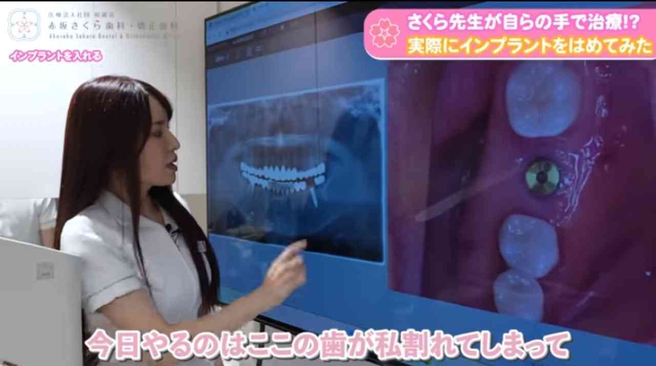 歯がボロボロ（今）、ボロボロだった（過去）ガル民