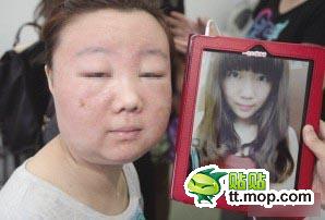 中国の美容サロンでニキビ治療をした19歳女性、顔が化粧品にかぶれて別人に…