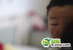 中国の美容サロンでニキビ治療をした19歳女性、顔が化粧品にかぶれて別人に…