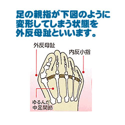 外反母趾の方、悩みを語り合いませんか？
