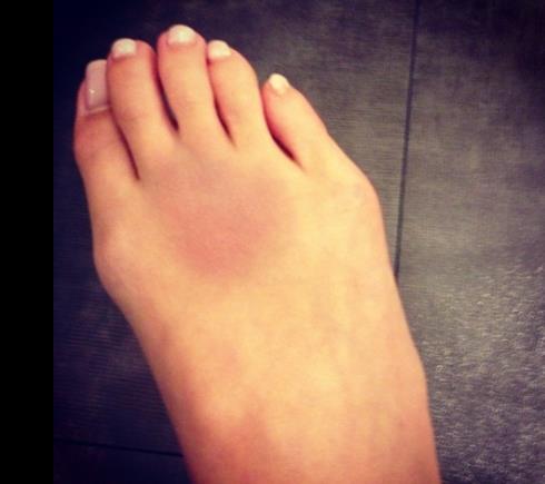 紗栄子、ビーサン激走で足にひび？ブログに腫れ上がった足の甲を公開