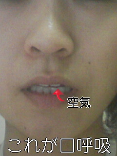 口呼吸してる人大変だ！！美容の大敵で万病の元～！！ |カラキュレ｜健康・病気・美容の情報まとめサイト