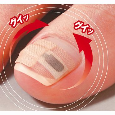 巻き爪で悩んでる人！