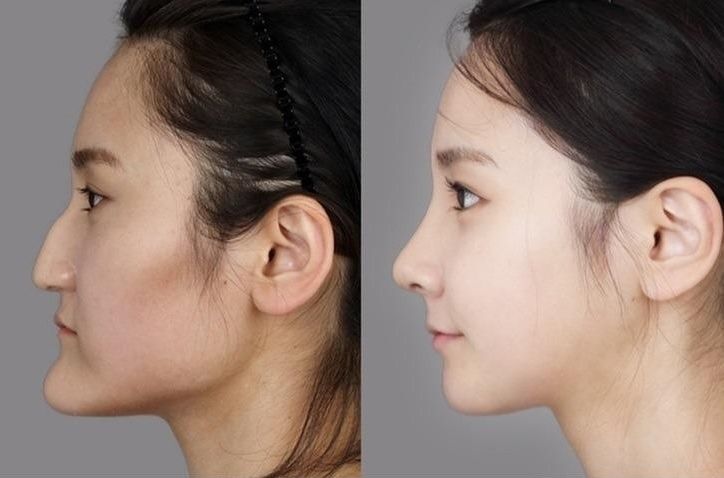 行き過ぎた韓国の美容整形ブーム…「こんなに美しくなった！」とあおるテレビ番組のせい