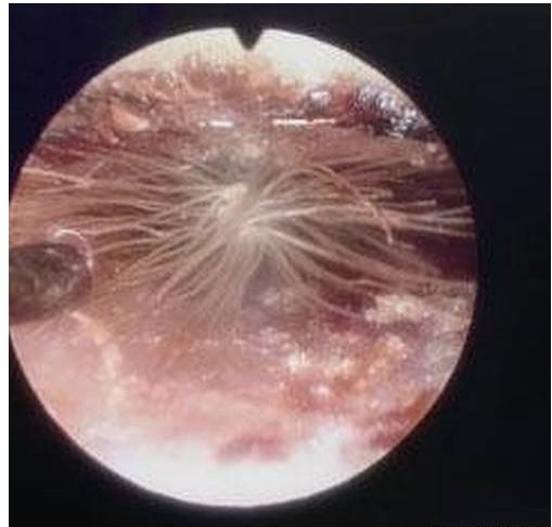 【閲覧注意】女児の耳の中でタンポポ発芽→2cmほど成長（脳に達する恐れもあった）→全身麻酔手術で取り除く