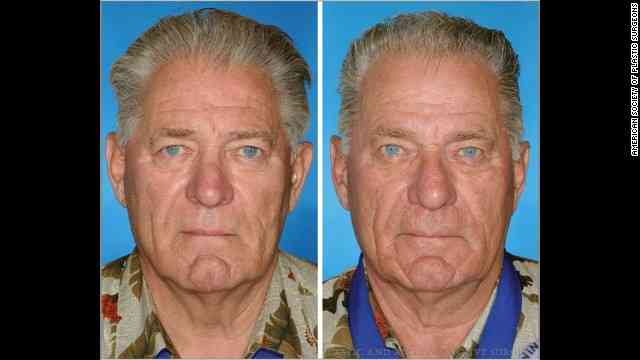 喫煙者・非喫煙者の双子を比べた結果…