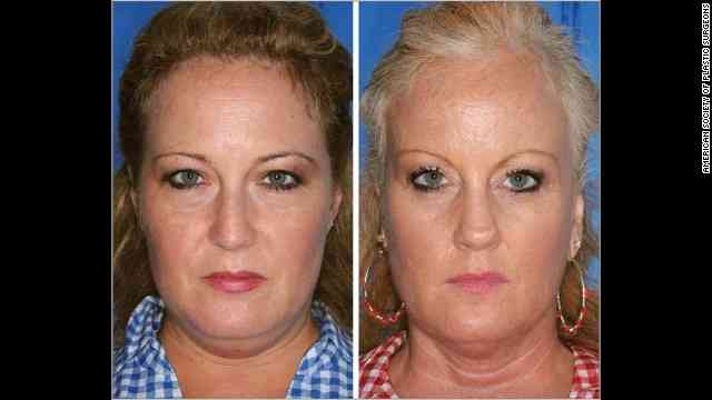 喫煙者・非喫煙者の双子を比べた結果…