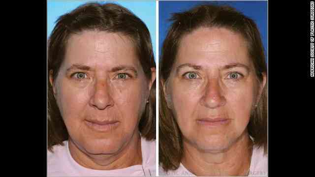  喫煙で顔が老化、双子７９組で検証　米研究