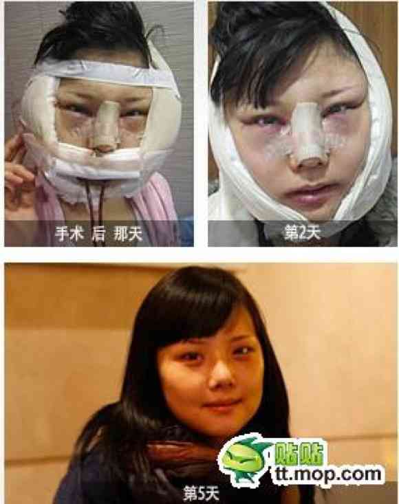 【閲覧注意】包帯グルグル巻きの姿はまるでケガ人 整形後の時間をホテルで過ごす女性たちのリアル