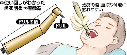 歯削る機器、滅菌せず再使用７割…院内感染懸念