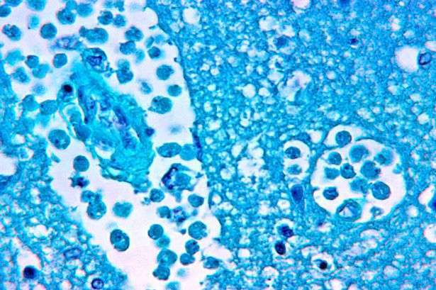 9歳女児がアメーバに脳を食われて死亡、水遊び中に感染