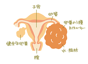 卵巣嚢腫、腫瘍と言われた方