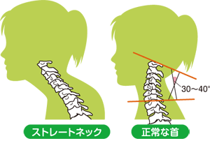 ストレートネックで悩んでいる方