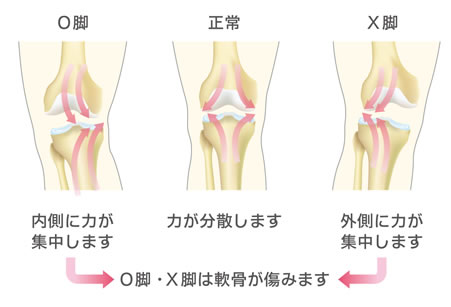 X脚について。
