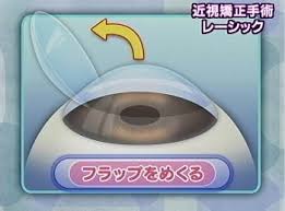 レーシックしてる方いますか？