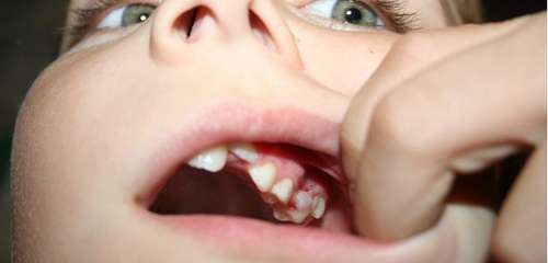 7歳女児の口から202本の歯が摘出される…