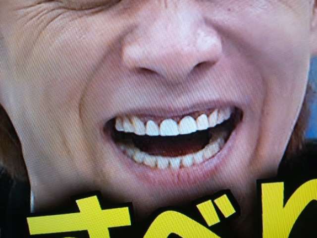 口元をいじったせいで残念になった芸能人は？