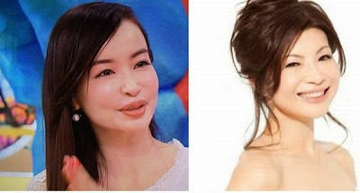 口元をいじったせいで残念になった芸能人は？