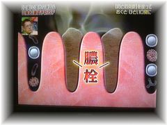 膿栓に悩まされてる方いませんか〜