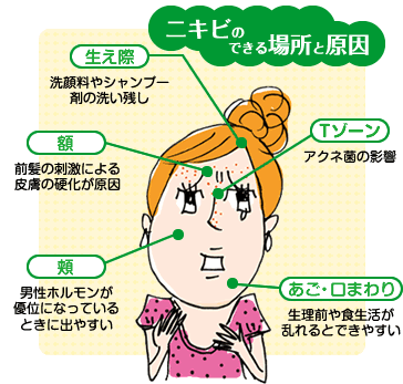 ニキビにお悩みの方(T_T)