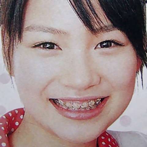 口元をいじったせいで残念になった芸能人は？