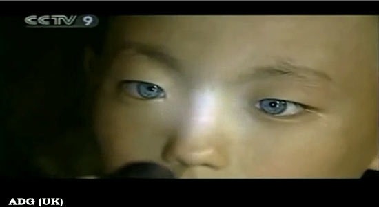 レーザーによりブルーの瞳を手に入れる!?米国でもすでに実験段階。