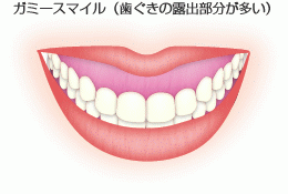 ガミースマイルさんお集まりください