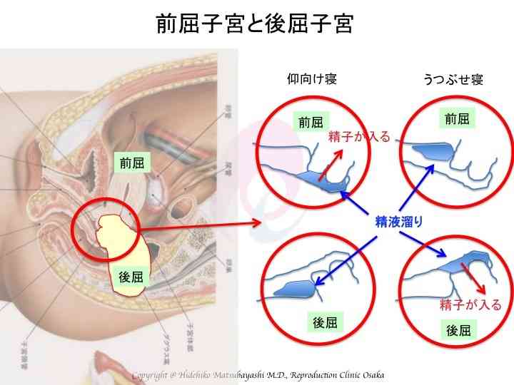 ☆子宮後屈の方へ ワンポイントアドバイス｜松林 秀彦 （生殖医療専門医）のブログ