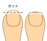 巻き爪の治し方