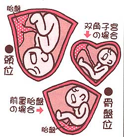 妊娠中の逆子