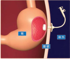 胃ろう（PEG）とは？｜胃ろう入門｜NPO法人PDN
