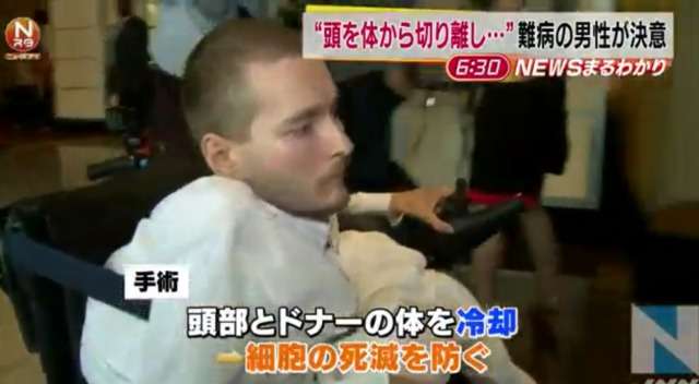 「頭を体から切り離し他人と結合」難病男性が手術へ