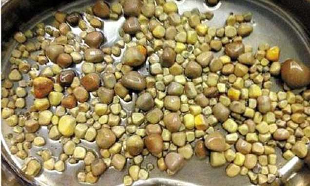 Chinese man has 420 kidney stones removed after too much tofu | Daily Mail Online