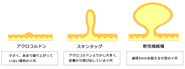 首にできる小さいイボ