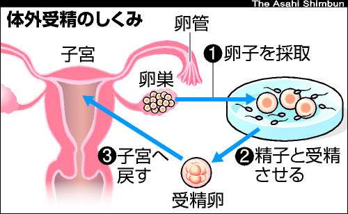 体外受精を考えている方、したことある方