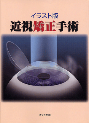 レーシック後に視力が落ちた方
