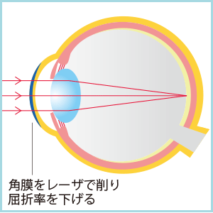 レーシック後に視力が落ちた方