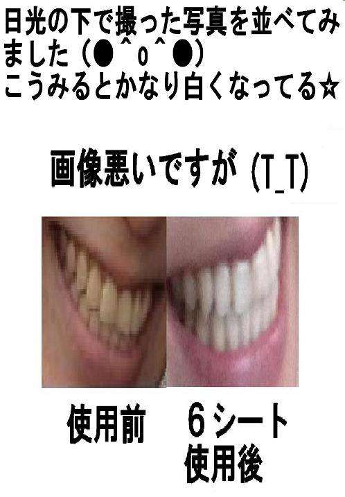 歯の色素沈着（着色）について語りましょう