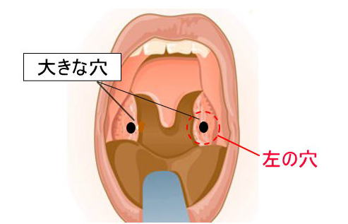 口臭予防