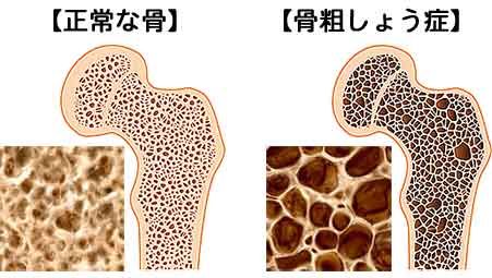 若い頃より身長が3センチ低くなったら…骨粗しょう症に要注意！