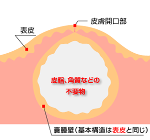 粉瘤の手術した事ある人！