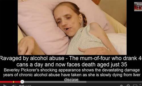 飲酒で老人になった35歳の女性…恐怖のアルコール依存症
