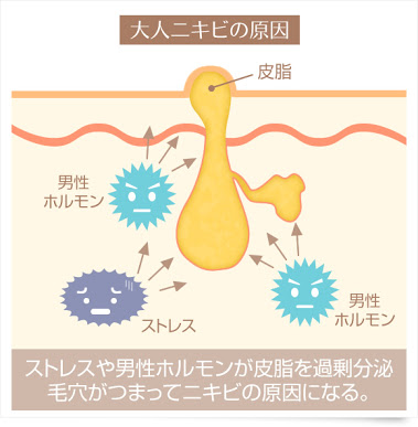 大人ニキビ