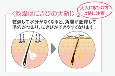 大人ニキビ