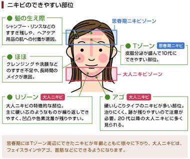 大人ニキビ