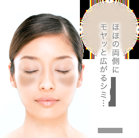 肝斑について