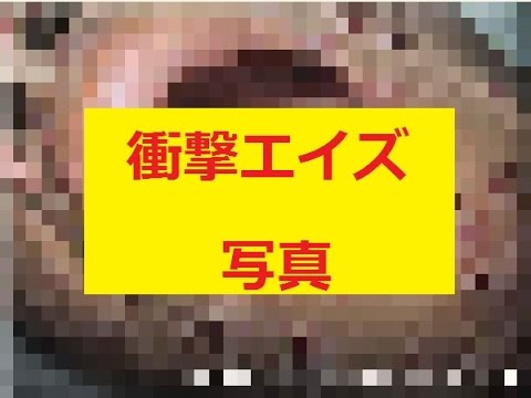 【閲覧注意】 エイズの画像見たら怖すぎて震えた・・・・ （画像あり） - YouTube